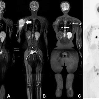 Images In A Year Old Female Patient With Li Fraumeni Syndrome Who