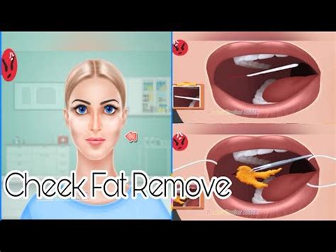 ASMR Cheek Fat Remove Surgery Animation Buccal Fat Remove Treatment