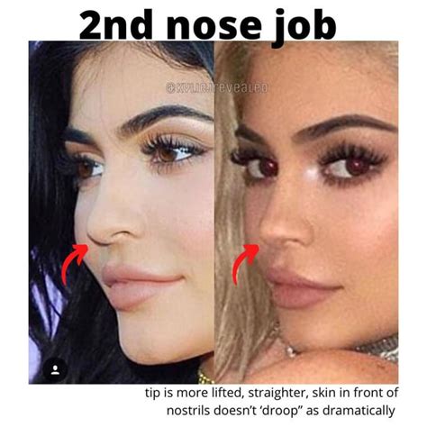 Male Kim Kardashian Wannabe Has Second Nose Job And Chin Implant But