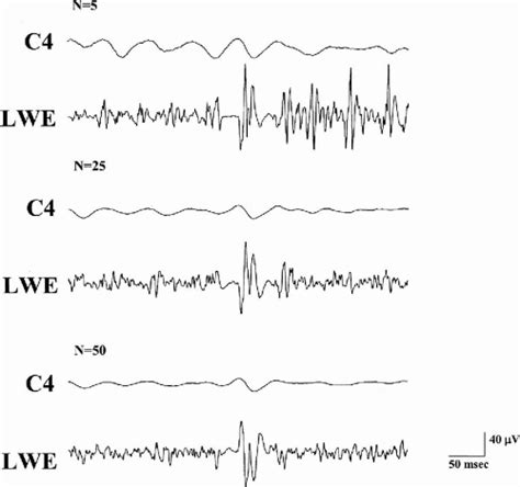 Pathophysiology Of Myoclonic Epilepsies Neupsy Key