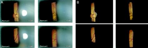 Mosaicking And Enhancement Of Slit Lamp Biomicroscopic Fundus Images