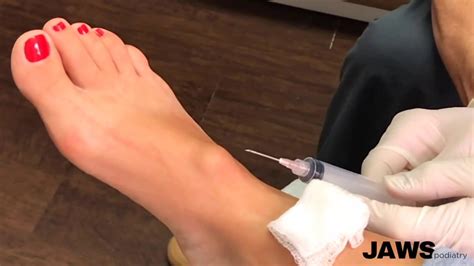 Recovery From Ganglion Cyst Removal On Foot Clearance