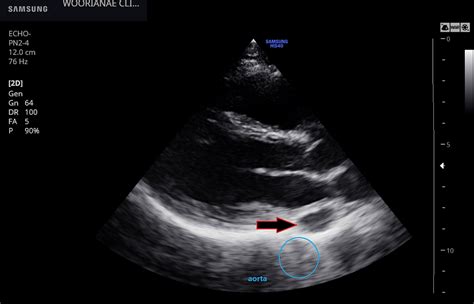 관정맥동 Coronary Sinus 보다는 쿠마딘 능선 Coumadin Ridge 좌심방 내부에