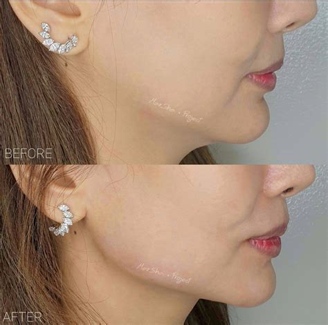 Non Surgical Jawline Sculpting And Contouring