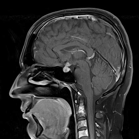 Pituitary Metastasis Radiology Case Radiopaedia Org