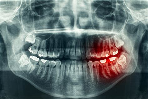 Answers to Concerns about Dental X-Ray Radiation | Pella, IA