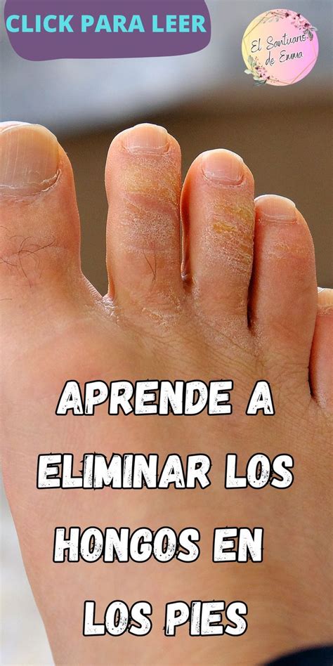 Elimina Los Hongos En Los Pies Artofit