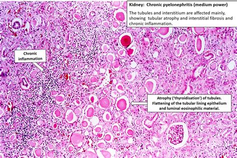 Chronic Pyelonephritis Histology