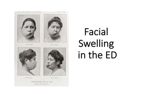 Facial Edema Pictures Telegraph