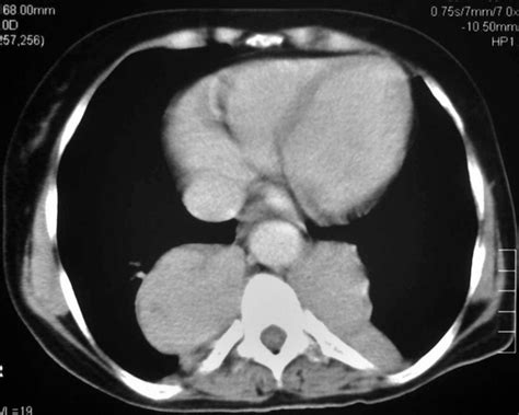 Unusual Cause Of Mediastinal Widening Bmj Case Reports