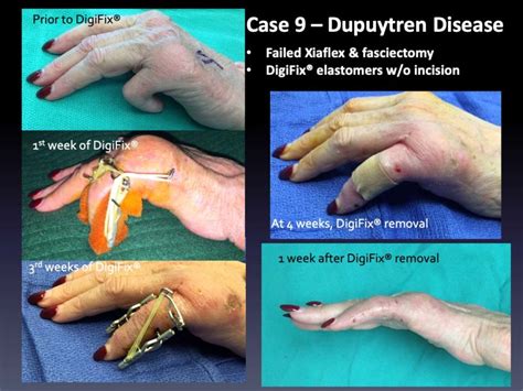 Case 9 Dupuytren Disease Virak Orthopedics