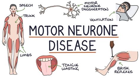 Understanding Motor Neurone Disease Amyotrophic Lateral Sclerosis