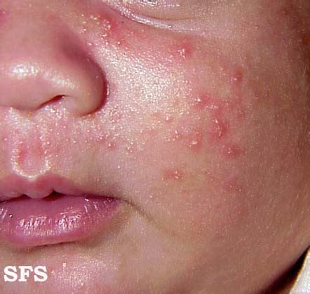 Neonatal acne - wikidoc