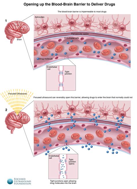 Blood Brain Barrier Disruption Focused Ultrasound Foundation Concept