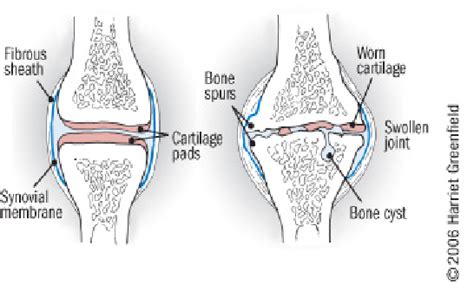 Knee Osteoarthritis Physiopedia