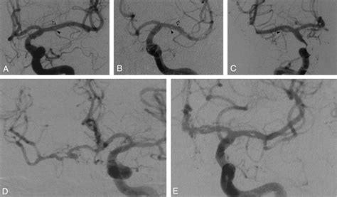 Five Angiographic Observations Of MCA Fenestration Anteroposterior