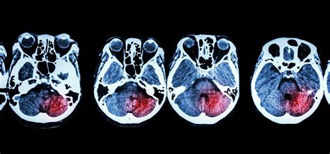 second impact syndrome | Task Force Concussion Blog