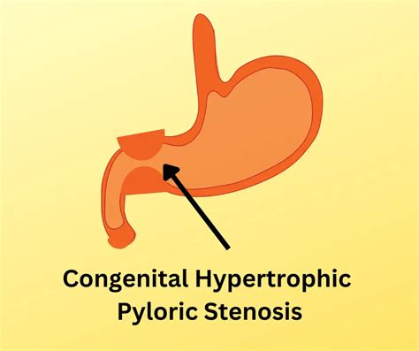 Congenital Hypertrophic Pyloric Stenosis Baby Vomiting Forcefully