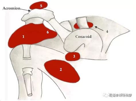 图文详解肩关节周围滑囊 箭头 三角肌 肌腱 下滑 喙突 健康界