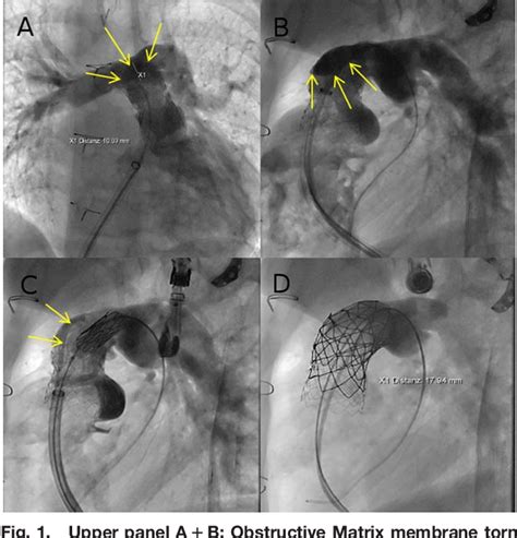 Figure 1 From VALVULAR AND STRUCTURAL HEART DISEASES Case Report