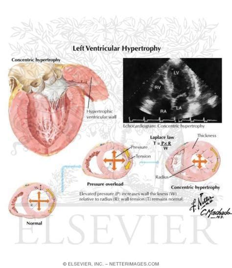 Left Ventricular Hypertrophy