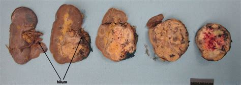 Clear cell renal cell carcinoma | Ottawa Atlas of Pathology