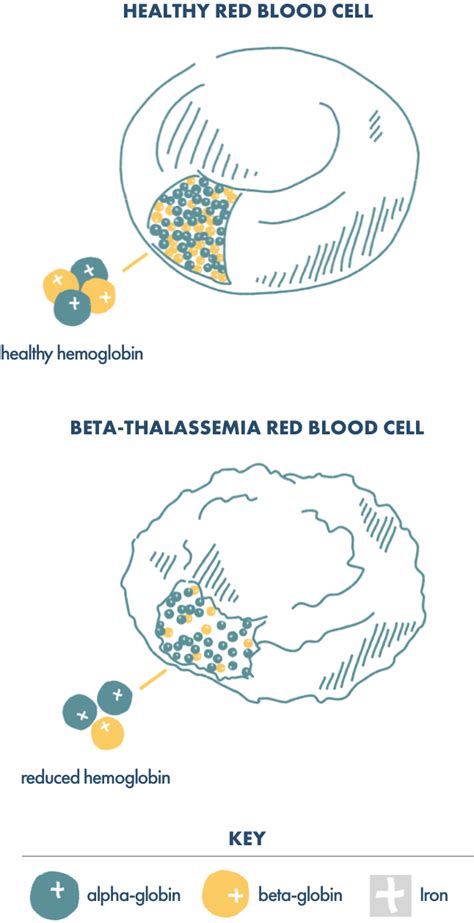 Beta Thalassemia Causes Understand Genetics And Inheritance