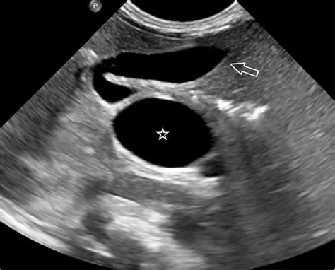 Choledochal Cyst Transverse Us Image Demonstrates A Normal Gallbladder