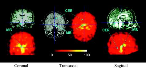 Biodistribution And Imaging With 123i Adam A Serotonin Transporter