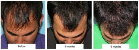 Hairline Lowering Vs Hair Transplantation Dr Jason Champagne