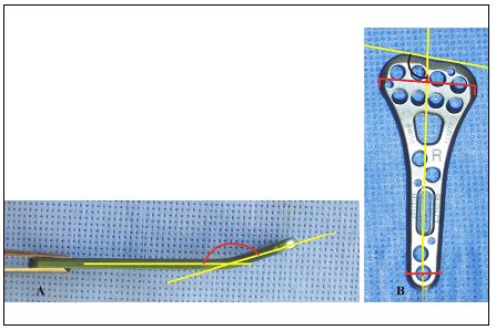 SciELO Brasil ANATOMICAL STUDY OF VOLAR FACE OF DISTAL RADIUS AND