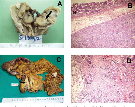 Figure 2 From Synchronous Gastric Gastrointestinal Stromal Tumor GIST