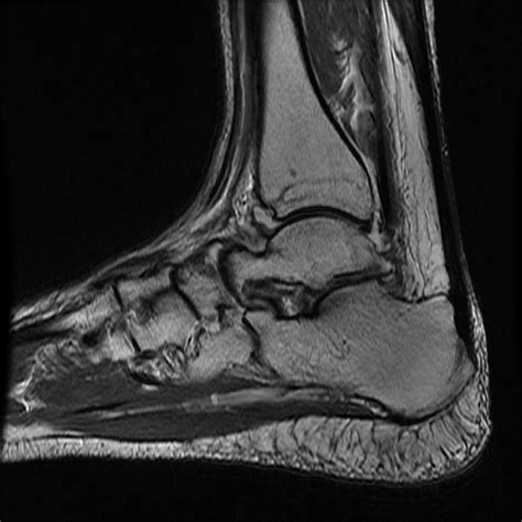 Anterior Ankle Impingement Image