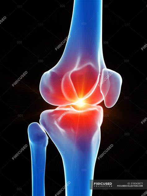 Human anatomy of knee pain, conceptual computer illustration. — arthrosis, abnormal - Stock