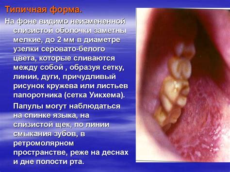 Красный плоский лишай - презентация онлайн