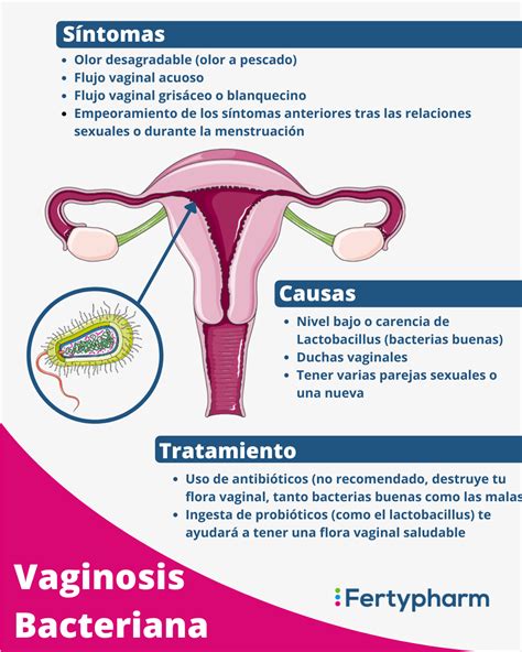 Vaginosis Bacteriana La Principal Causa De Las Infecciones Vaginales