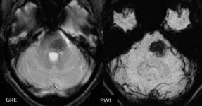 Capillary Telangiectasia Stroke Manual