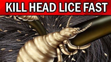 How To Get Rid Of Head Lice Fast Naturally And Permanently Youtube