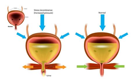 Why Does Pregnancy Cause Urinary Leakage