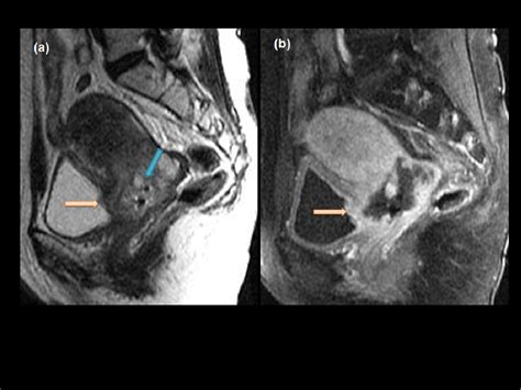 Cervical Cancer Staging Through Magnetic Resonance Imaging Mri — What