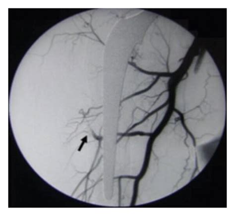 A Arteriography Showing The Pseudoaneurysm Pre Embolization B