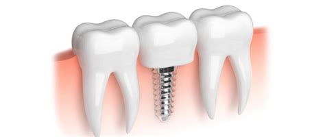 All About Pain During And After Dental Implants Periodonta