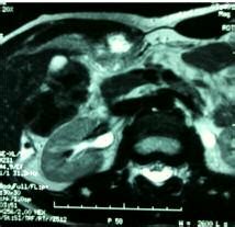 IRM abdominal : masse tumorale en hyper-signal T1 | Download Scientific ...