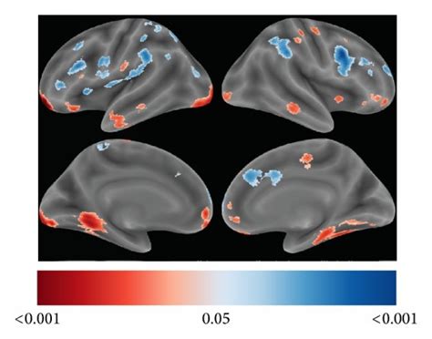 Whole Brain Statistical Maps Vbm Analyses Statistical Parametric Maps