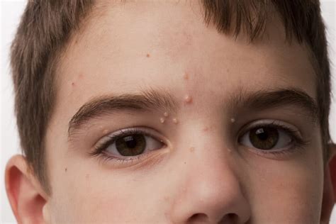 What Is Molluscum Contagiosum Hope Dermatology