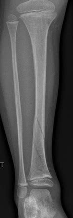 Spiral Fracture Tibia