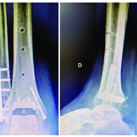 Case 2 Postoperative Right Ankle Radiographs In Anteroposterior Left