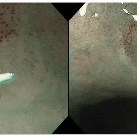 A Endoscopic Image Using Narrow Band Imaging Nbi Of The Case That