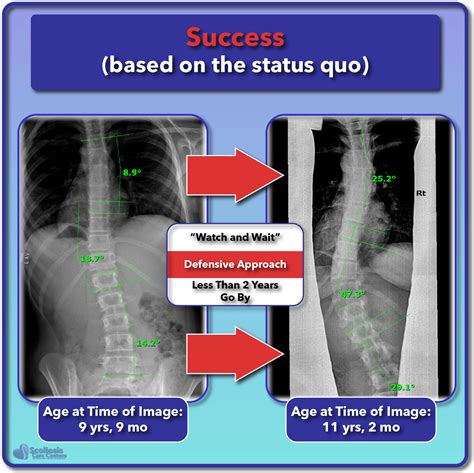 Scoliosis Treatment for Children and Teens - Scoliosis Care Centers