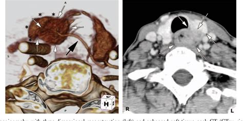 Figure 3 From Computed Tomographic Angiography With Three Dimensional Reconstruction For